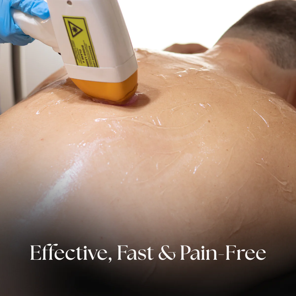 Back Laser Hair Removal - Image 5